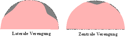 Laterale vs. Zentrale Verengung