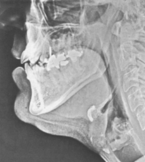 Röntgenaufnahme der Sprechorgane